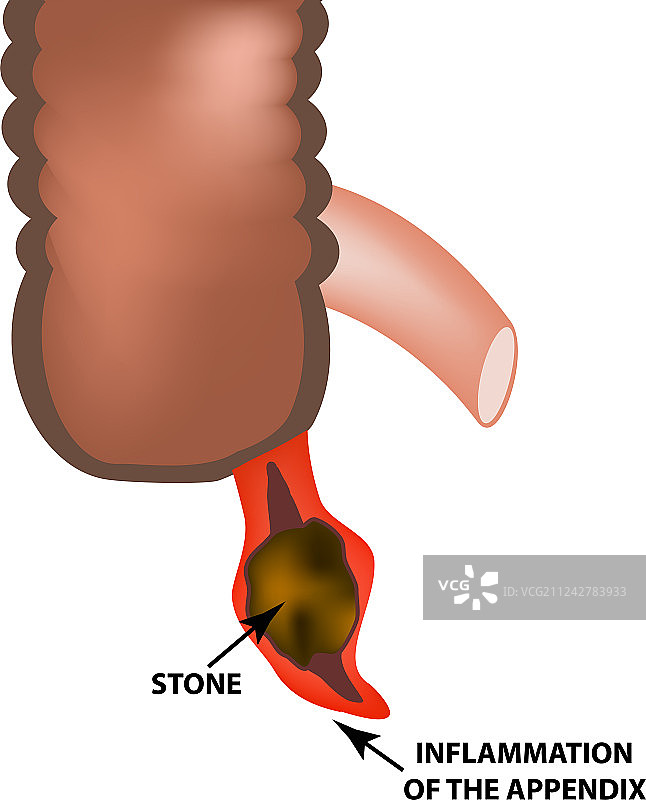阑尾炎图片素材