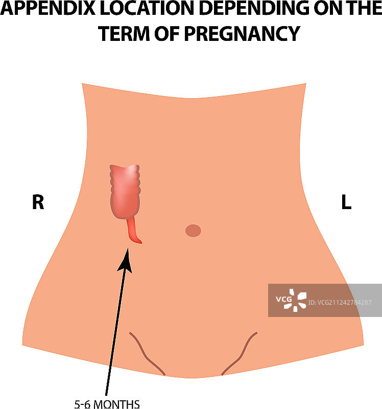 妊娠5-6个月的阑尾图片素材