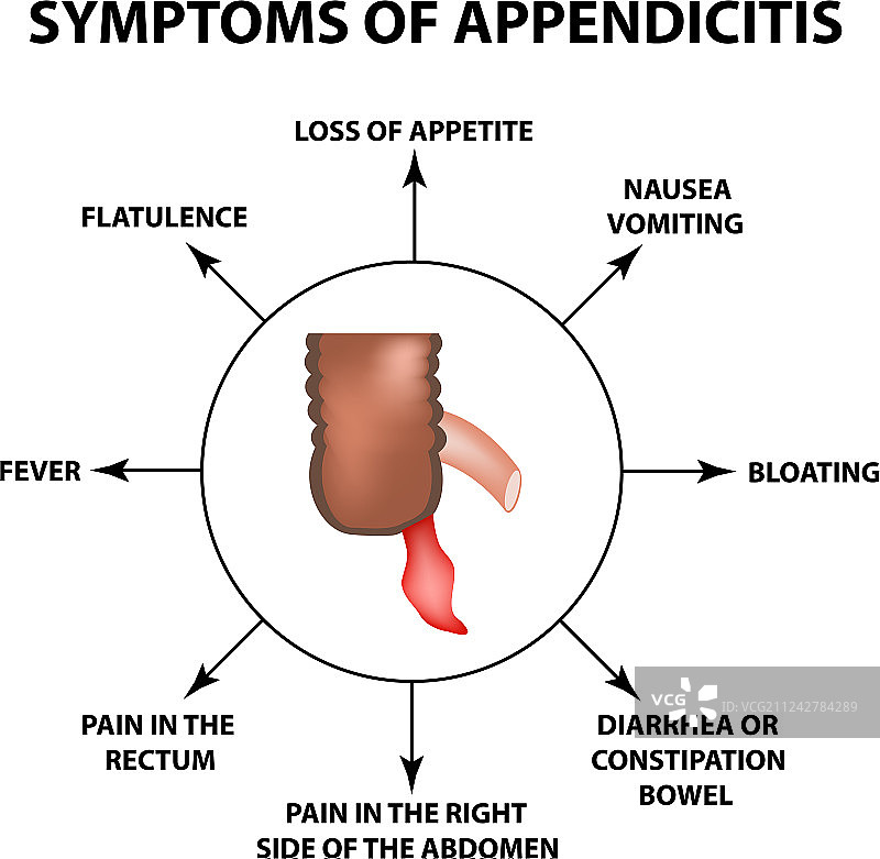 阑尾炎炎症症状图片素材