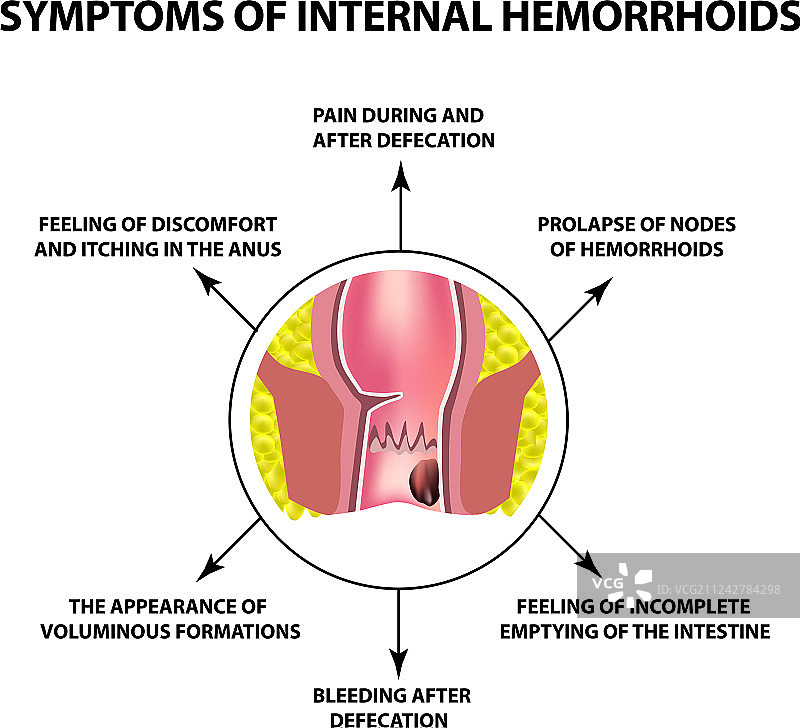 内痔痔核症状图片素材
