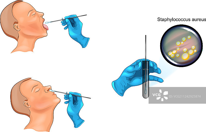 咽喉和鼻拭子图片素材