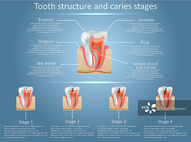 牙齿结构图和龋齿图片素材