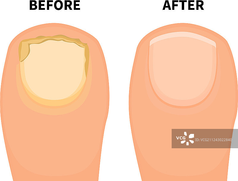 真菌病前后的脚趾甲图片素材