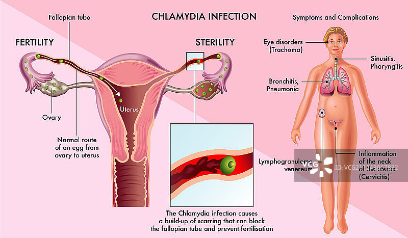 衣原体感染图片素材