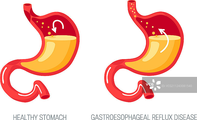扁平风格的胃食管反流病概念图片素材