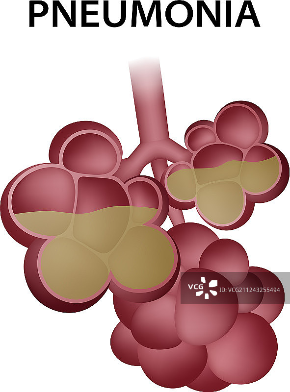 肺炎肺泡图标逼真风格图片素材