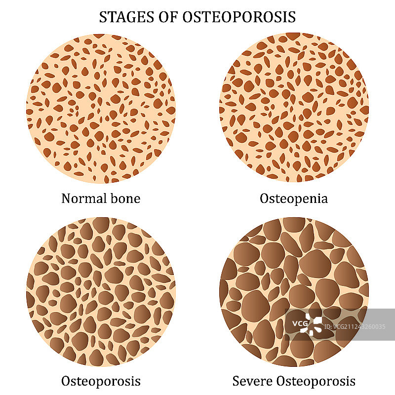 骨质疏松症的各个阶段图片素材