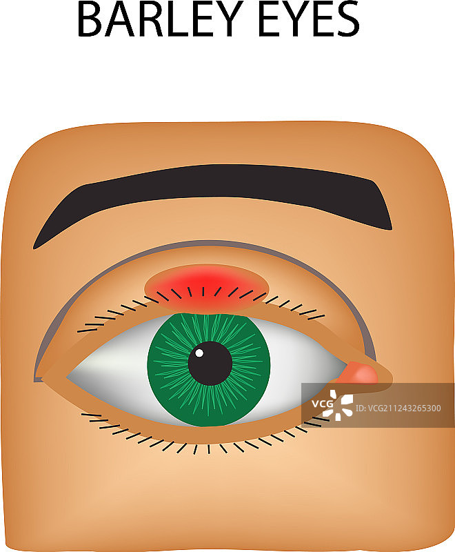 麦粒肿图片素材