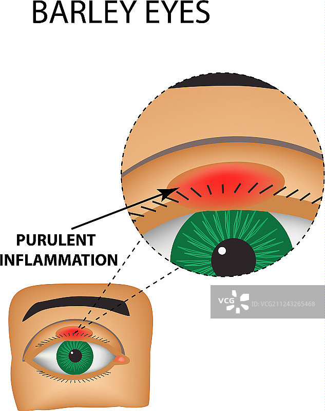 麦粒肿图片素材