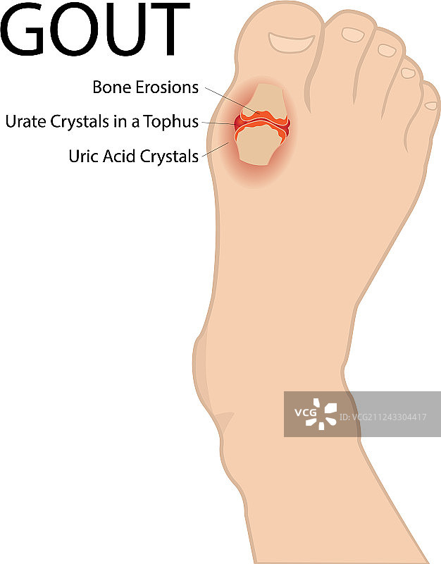 痛风性关节炎人足医学图片素材