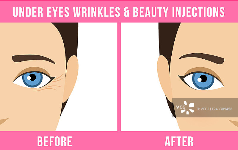 美容程序：肉毒杆菌图片素材