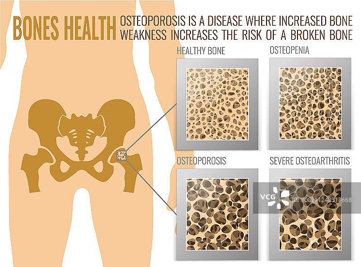 骨质疏松症骨骼海报图片素材