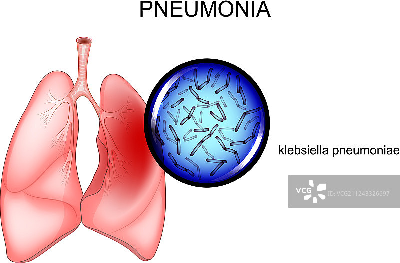 肺炎病原体——克雷伯菌图片素材