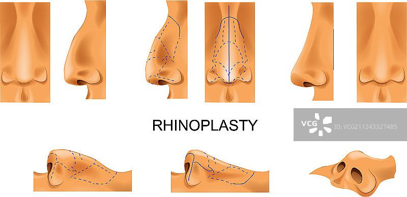 隆鼻整形手术图片素材