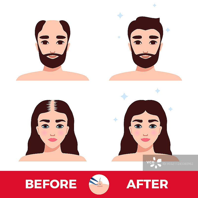 头发移植前后效果图片素材