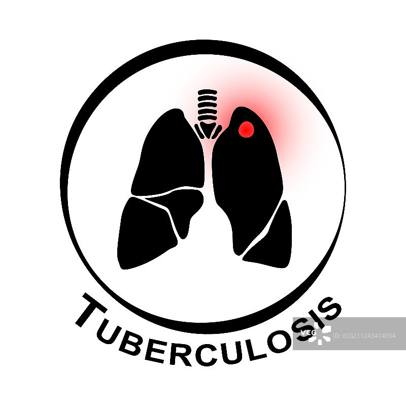 肺结核图片素材
