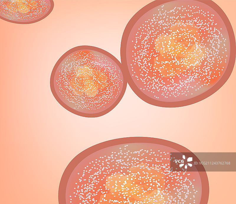 寻常型银屑病图片素材