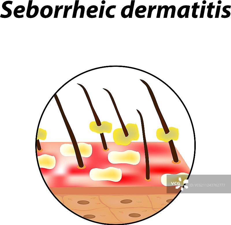 皮肤和头发的脂溢性皮炎图片素材