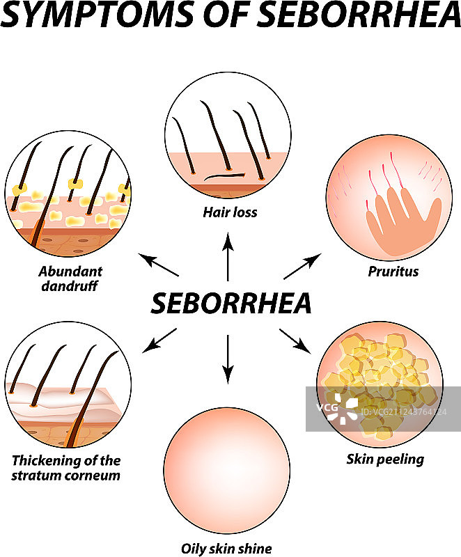 脂溢性皮炎的症状：皮肤和头发图片素材