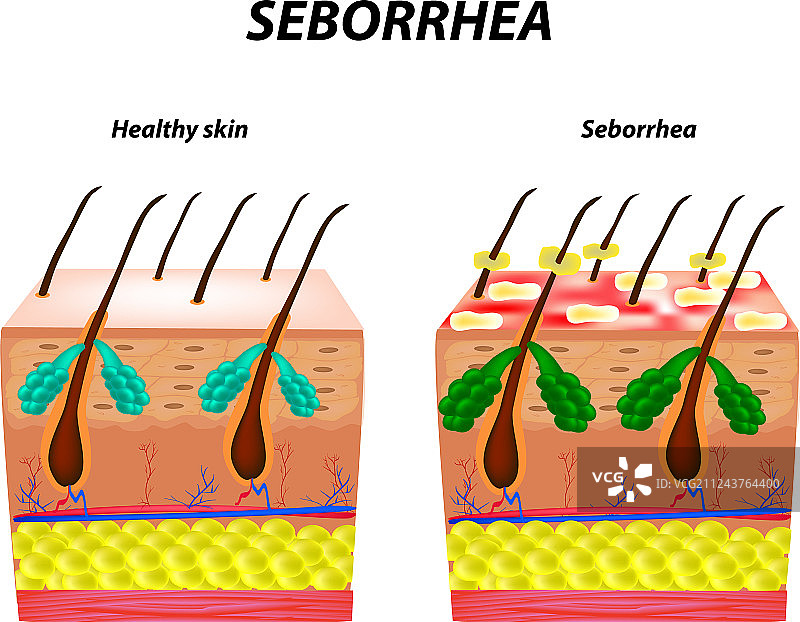 脂溢性皮炎皮肤和头发头皮屑图片素材