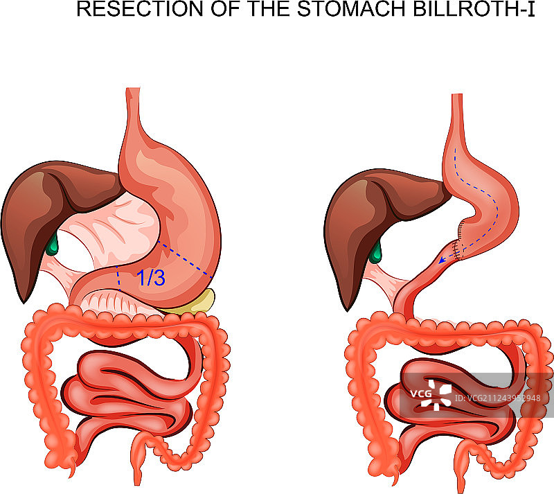 胃比尔罗特I式切除术示意图图片素材