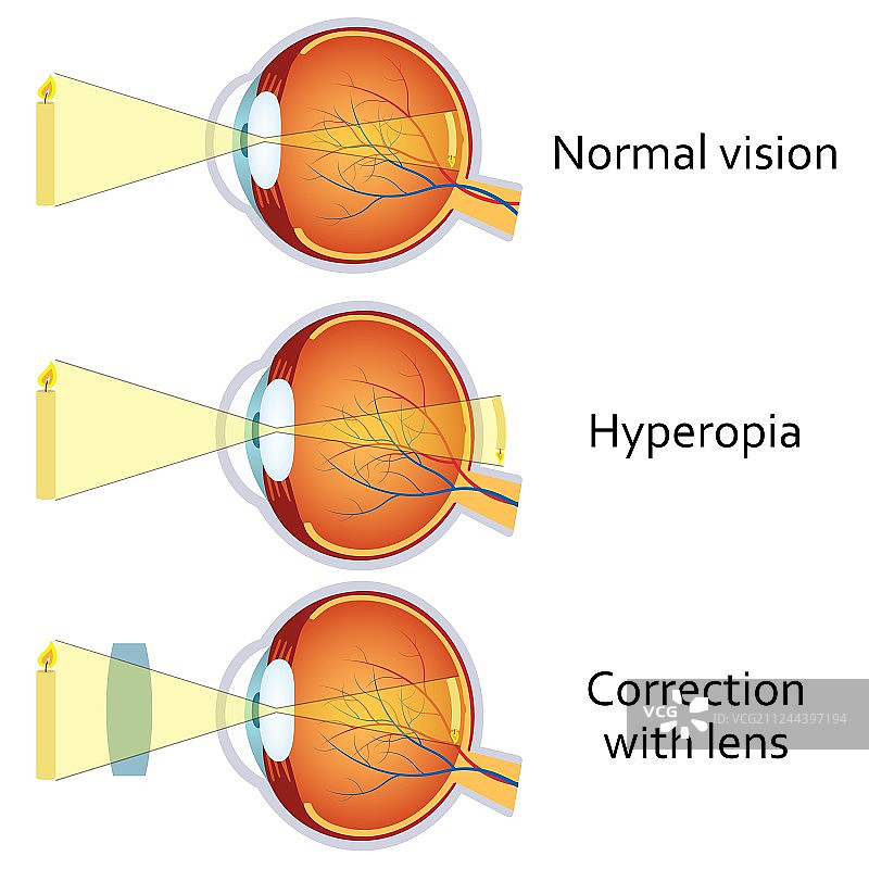 使用正透镜矫正远视图片素材