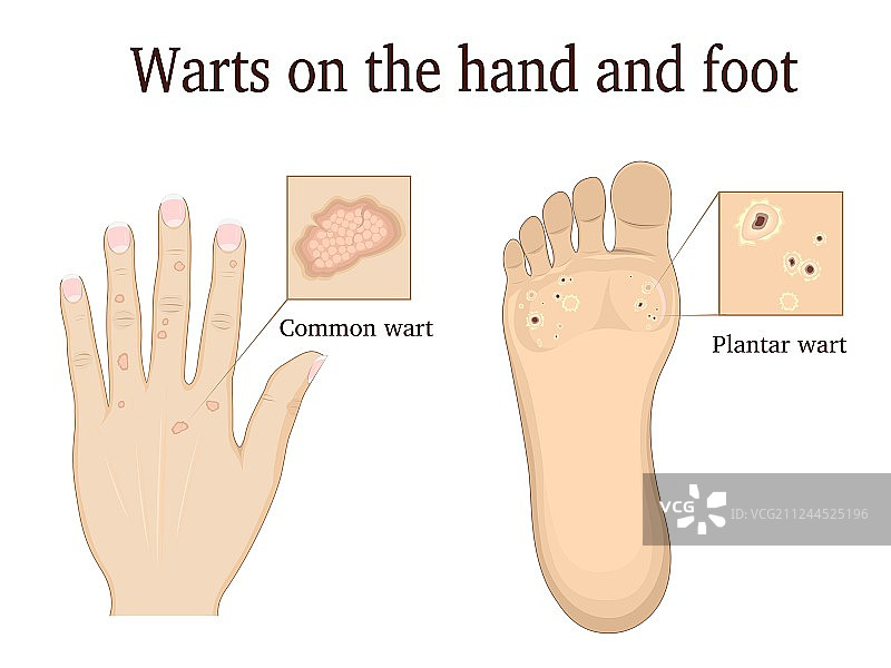 手和脚上的疣图片素材