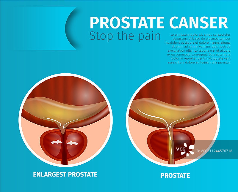 正常和增大前列腺的医疗banner图片素材
