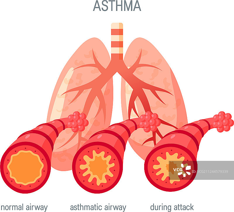 哮喘疾病扁平风格图标图片素材