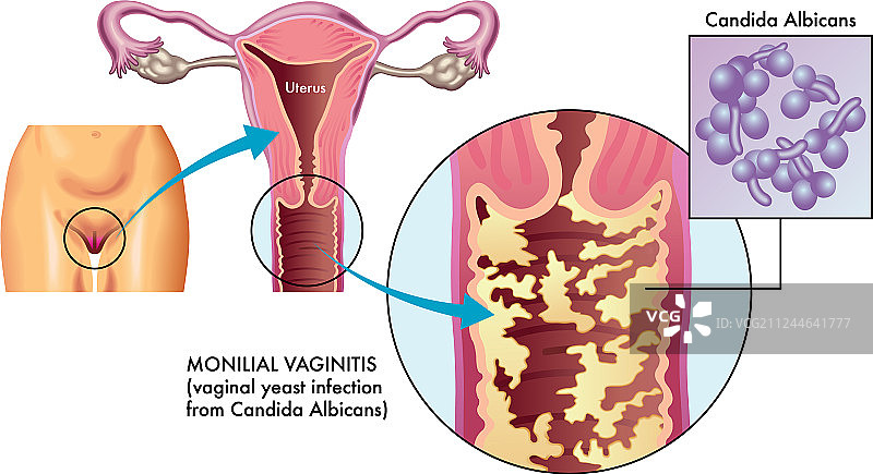 念珠菌性阴道炎图片素材