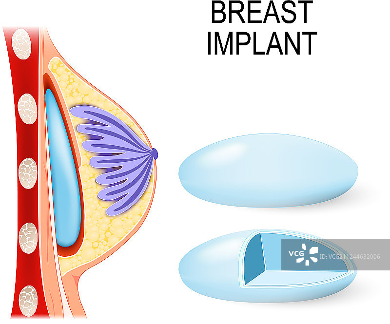 乳房植入体表面和横截面图图片素材
