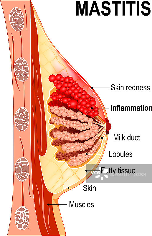 乳腺炎横截面图片素材