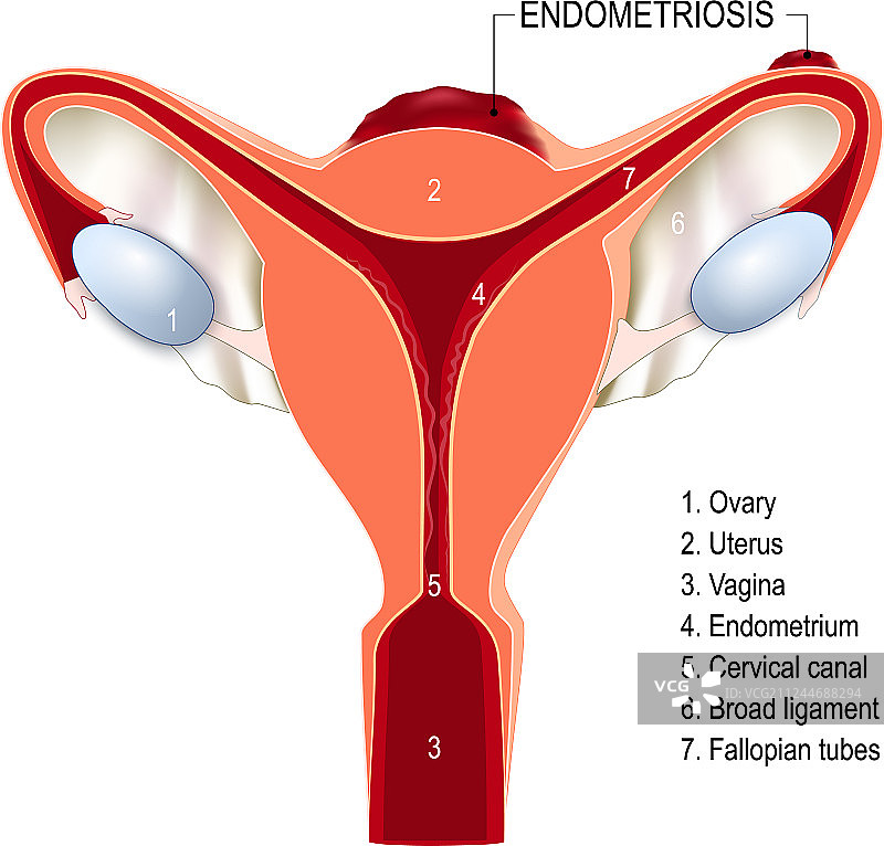 患有子宫内膜异位症的人体子宫图片素材