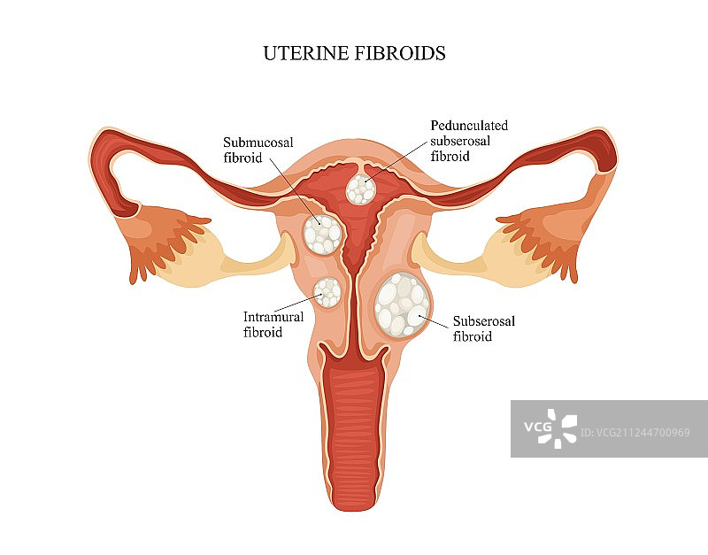 子宫肌瘤图片素材