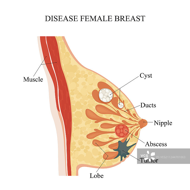 女性乳腺疾病图片素材