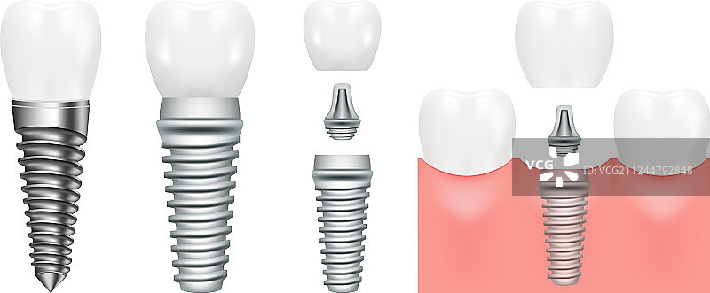 包含所有部件的逼真牙科植入体结构图片素材
