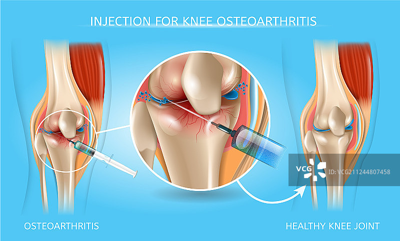 膝骨关节炎注射治疗医学图表图片素材