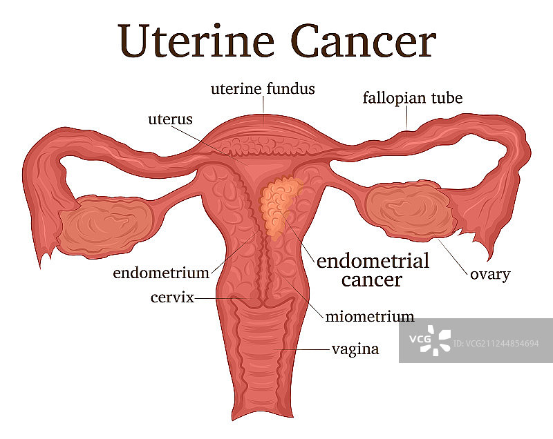 子宫癌图片素材