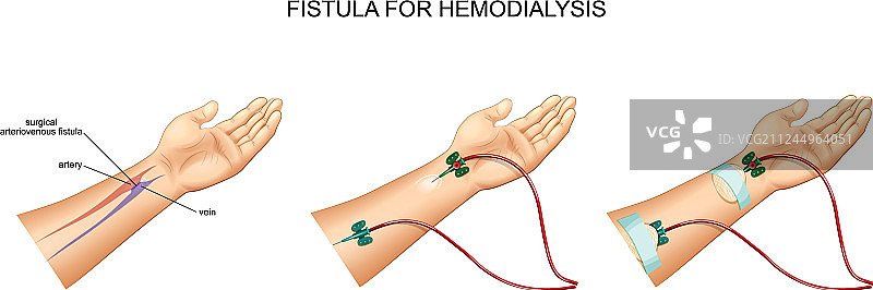 静脉导管血液透析和瘘管图片素材