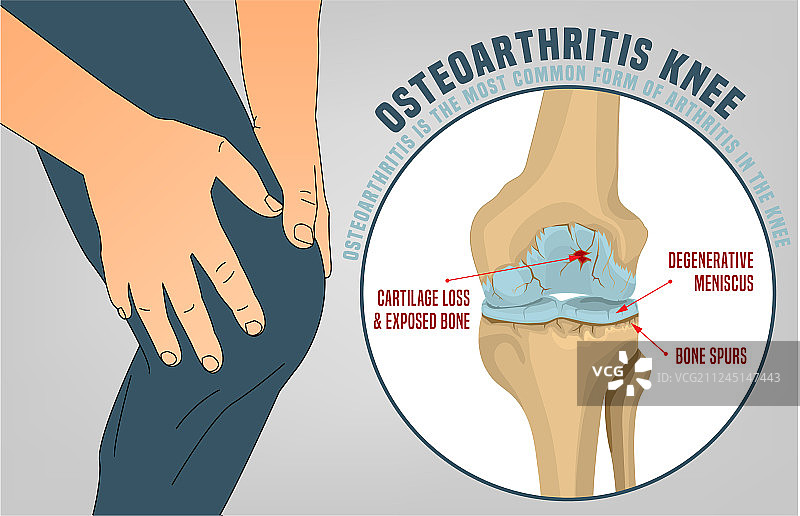 膝关节骨关节炎海报图片素材