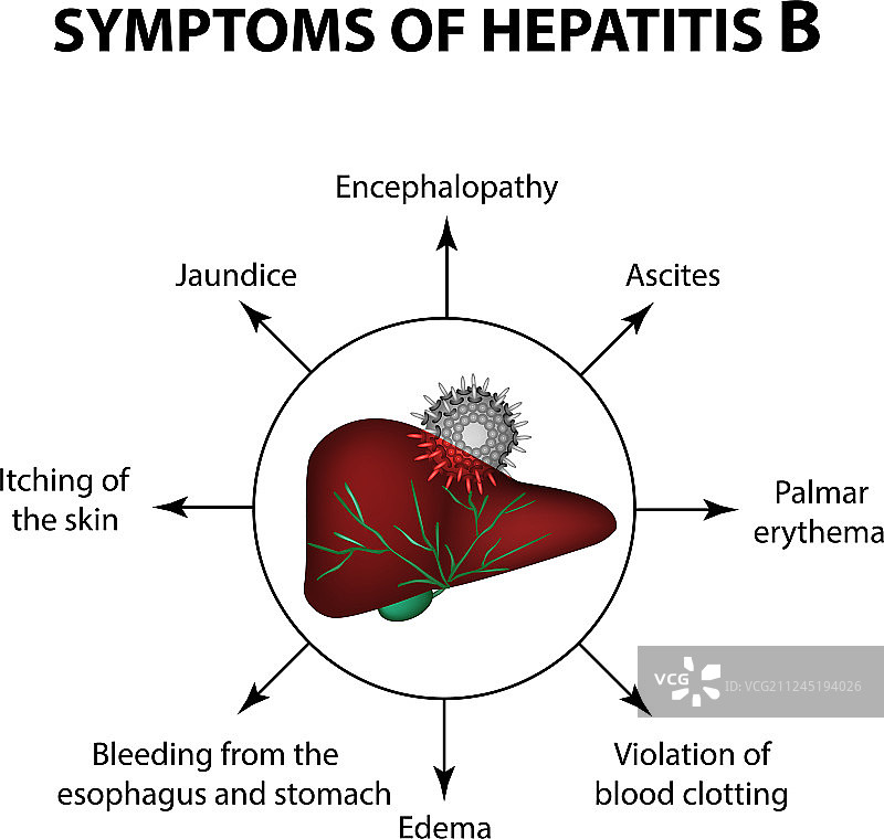 乙型肝炎症状图片素材