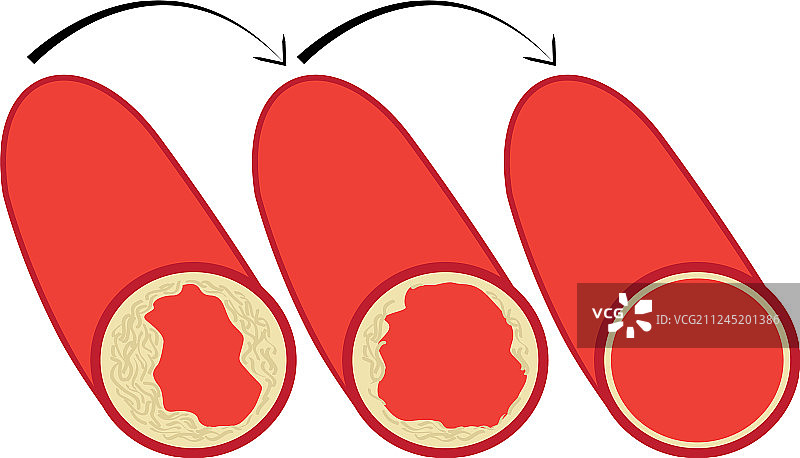 降低血管中胆固醇斑块水平图片素材