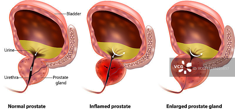 良性前列腺增生图片素材