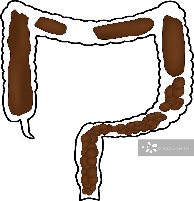 结肠内便秘粪便信息图图片素材