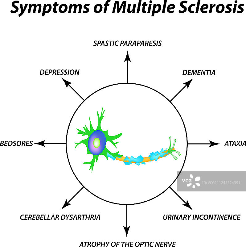多发性硬化症的症状：组织破坏图片素材