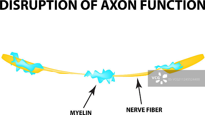 轴突上髓鞘的破坏图片素材