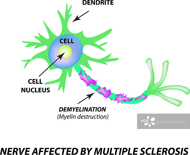 轴突上髓鞘的破坏图片素材