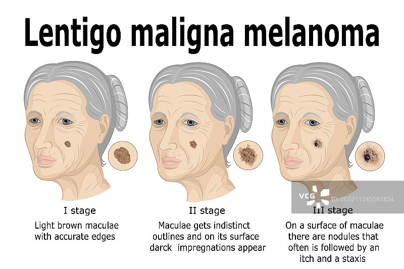 恶性雀斑痣型黑色素瘤图片素材