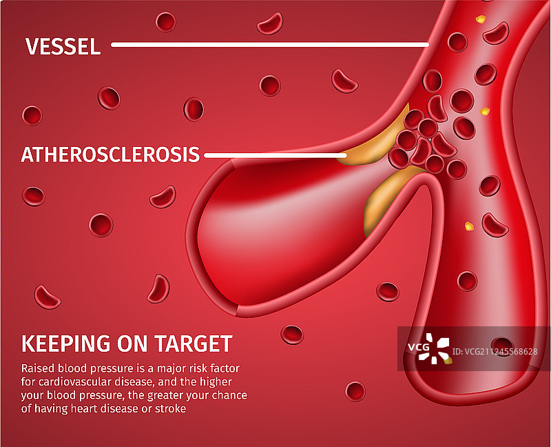 动脉粥样硬化血管疾病医学banner图片素材