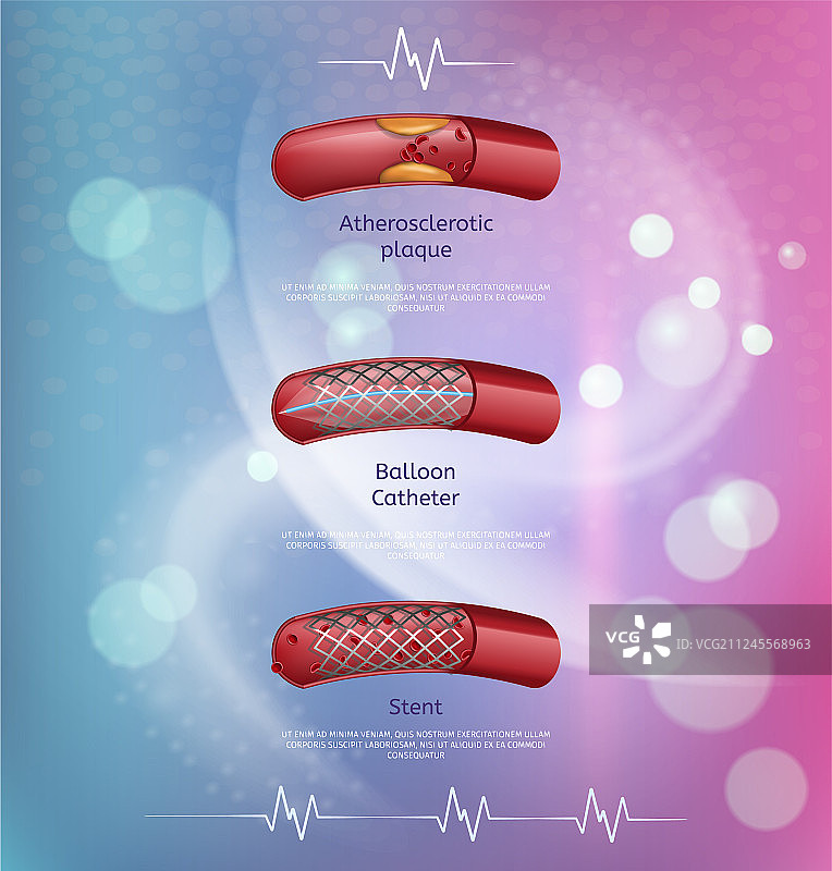 胆固醇疾病处理方法banner图片素材